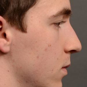 403 hump reduction rhinoplasty - dr. Oakley Smith - top toronto nose job surgeon