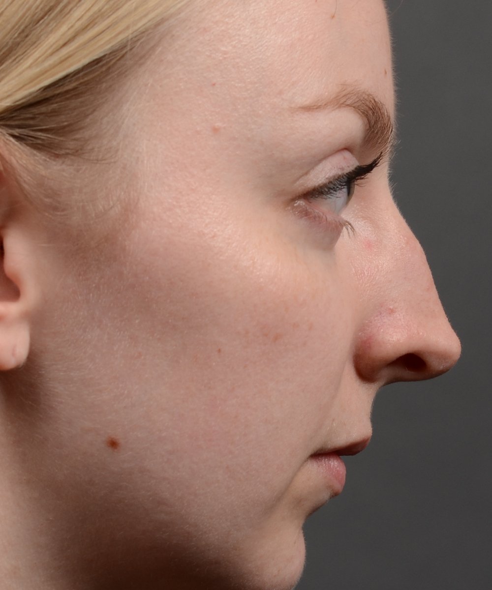 406 top rhinoplasty, dr oakley smith, toronto, nose job Toronto