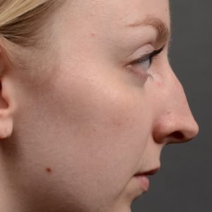 406 - Expert Rhinoplasty nose job surgery to reduce the bump on this womans nose.