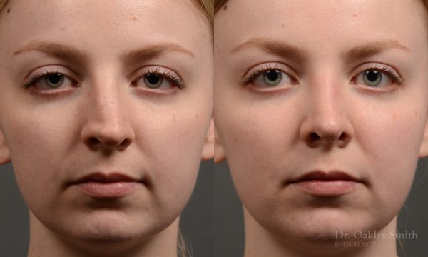 406 - Expert Rhinoplasty nose job surgery to reduce the bump on this womans nose.