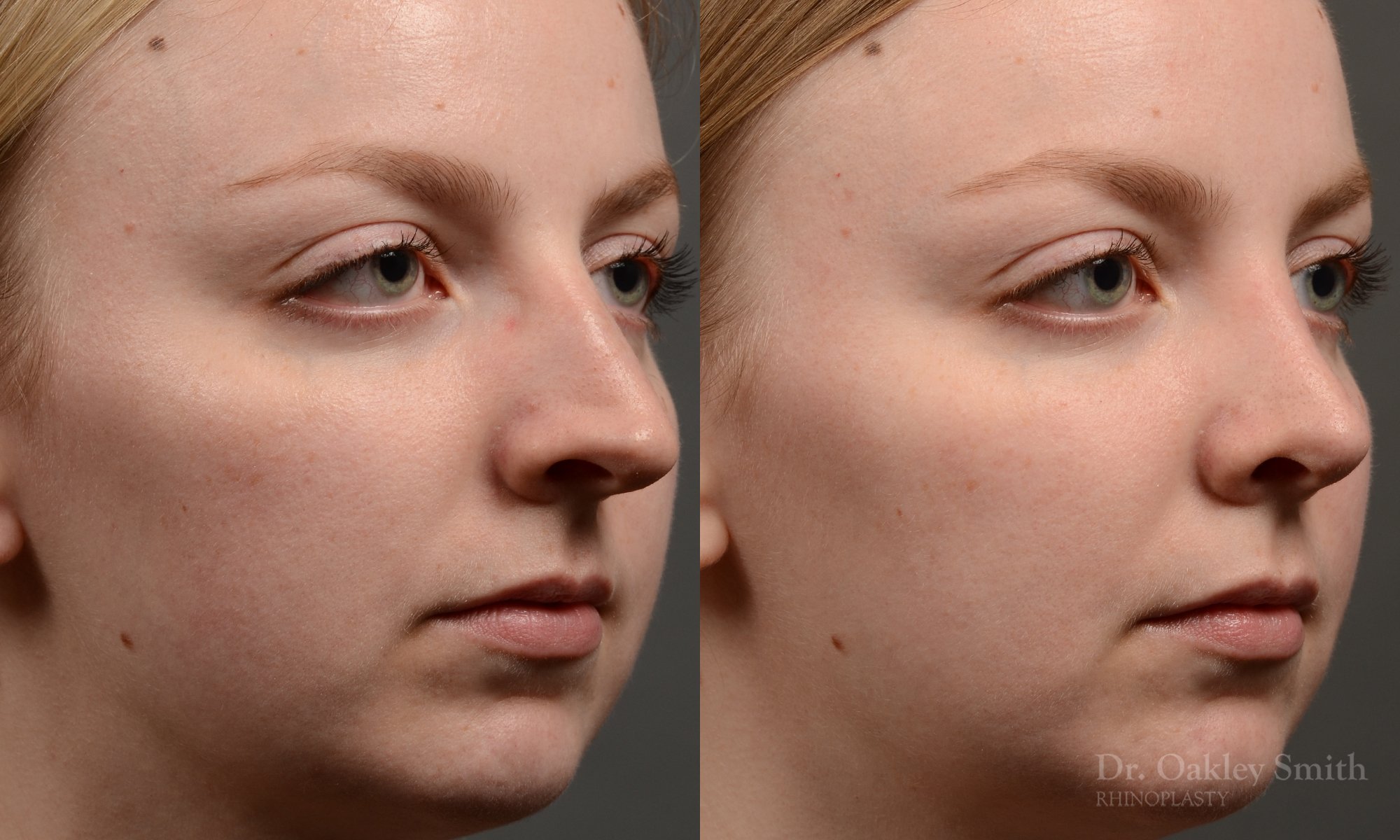 406 - Expert Rhinoplasty nose job surgery to reduce the bump on this womans nose.