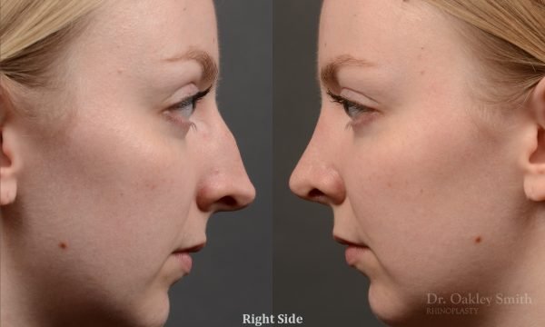 406 - Expert Rhinoplasty nose job surgery to reduce the bump on this womans nose.
