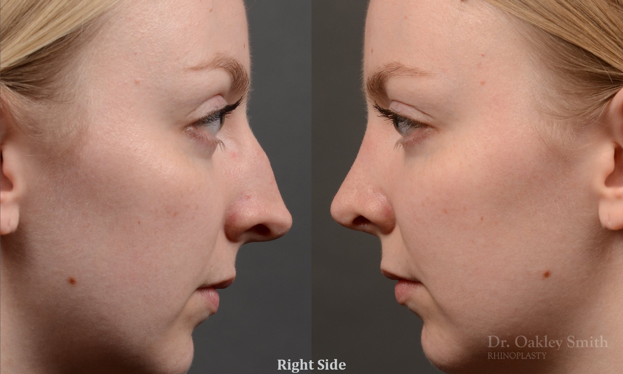 406 - Expert Rhinoplasty nose job surgery to reduce the bump on this womans nose.