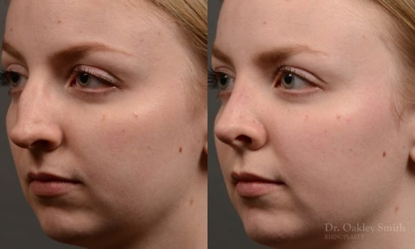406 - Expert Rhinoplasty nose job surgery to reduce the bump on this womans nose.