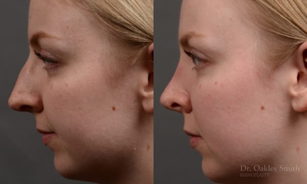 406 - Expert Rhinoplasty nose job surgery to reduce the bump on this womans nose.