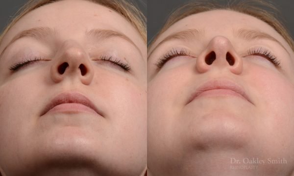 406 - Expert Rhinoplasty nose job surgery to reduce the bump on this womans nose.