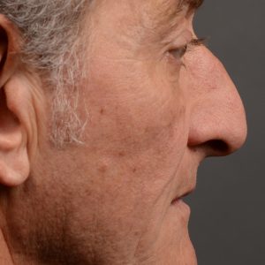 407 - Expert toronto rhinoplasty surgeon - dr. oakley smith - hump reduction, overall size reduction