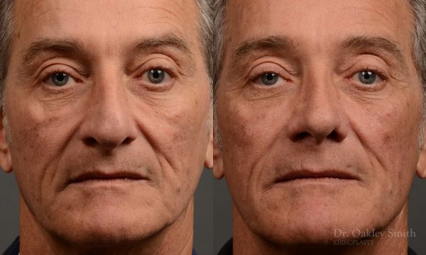 407 - Expert toronto rhinoplasty surgeon - dr. oakley smith - hump reduction, overall size reduction