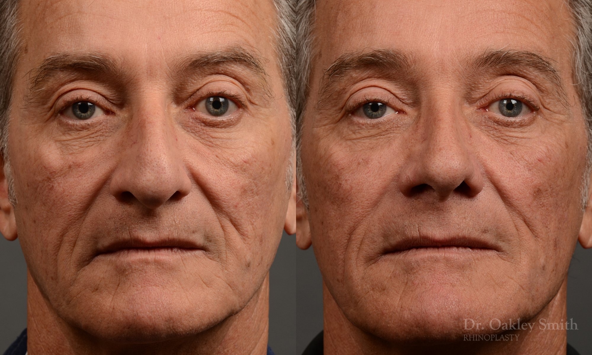 407 - Expert toronto rhinoplasty surgeon - dr. oakley smith - hump reduction, overall size reduction