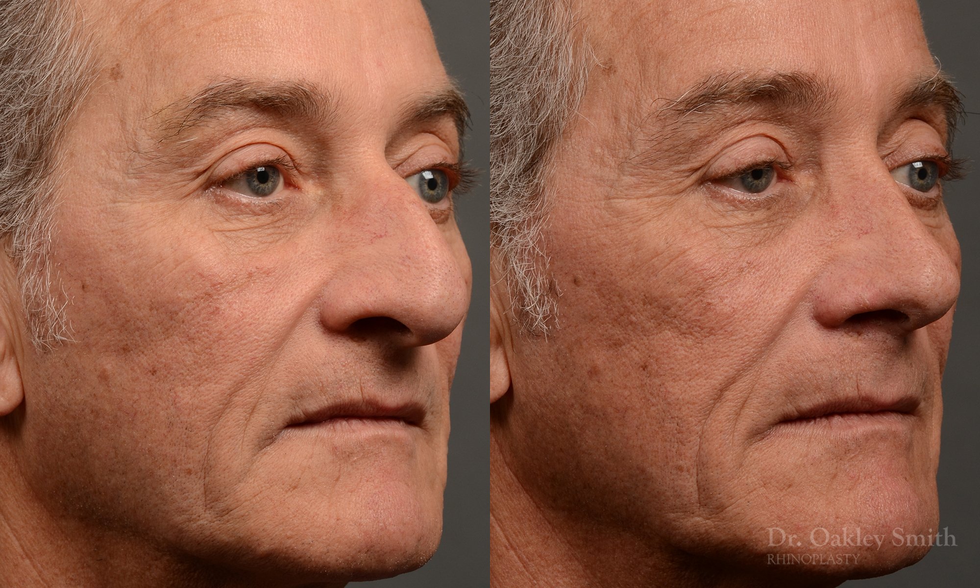 407 - Expert toronto rhinoplasty surgeon - dr. oakley smith - hump reduction, overall size reduction