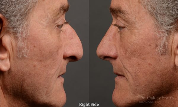407 - Expert toronto rhinoplasty surgeon - dr. oakley smith - hump reduction, overall size reduction