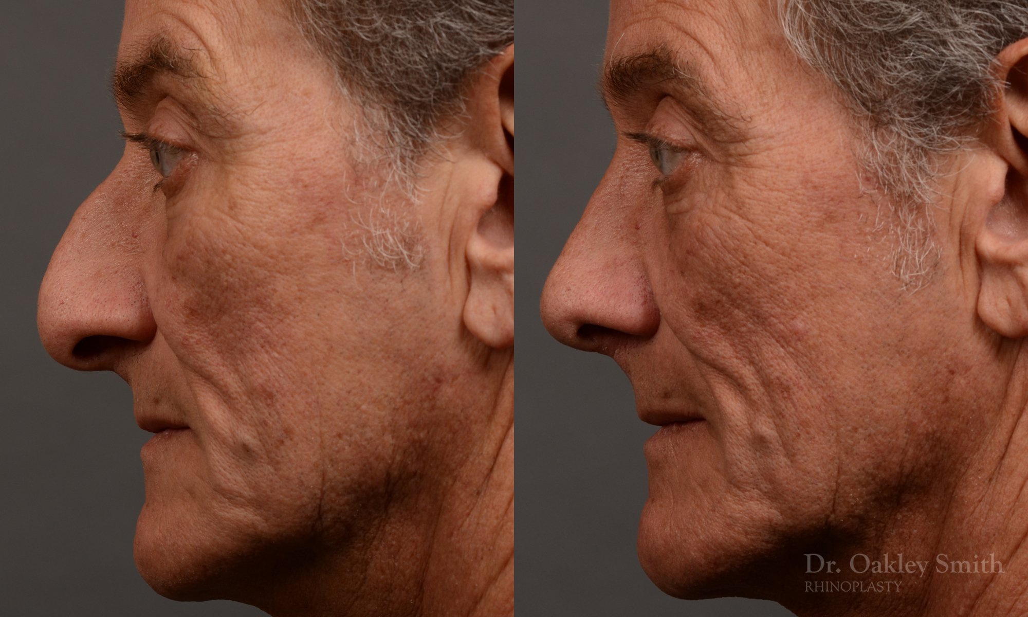407 - Expert toronto rhinoplasty surgeon - dr. oakley smith - hump reduction, overall size reduction