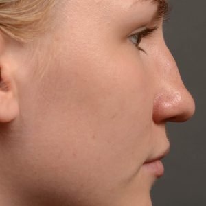 408 rhinoplasty, dr oakley smith, toronto, top surgeon, nose job