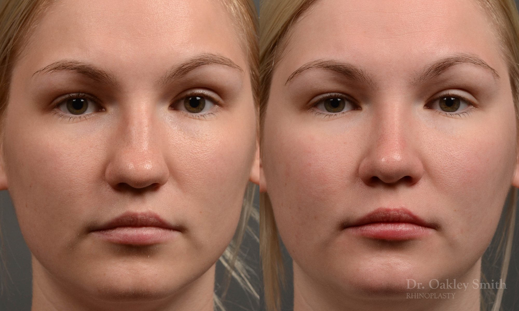 408 rhinoplasty, dr oakley smith, toronto, top surgeon, nose job