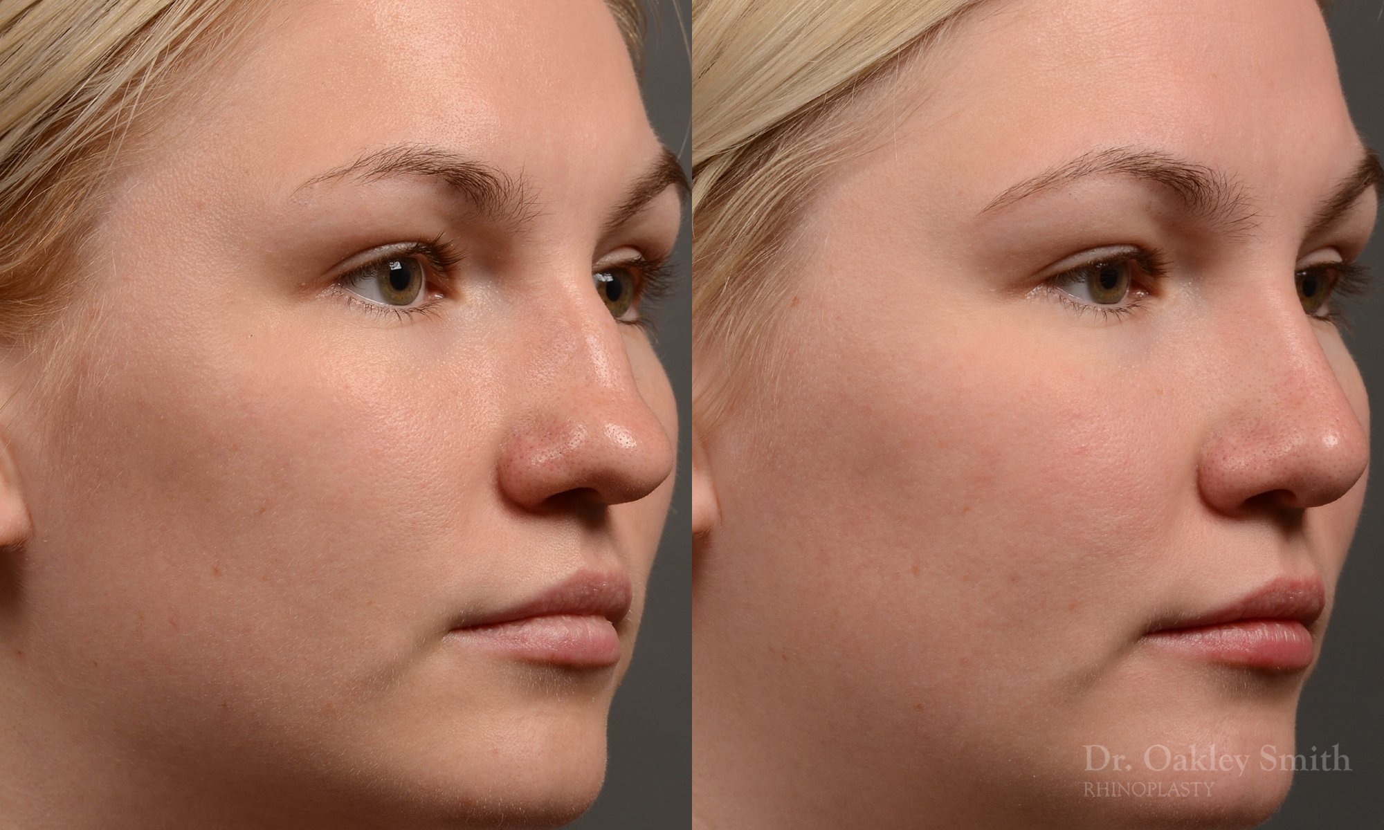 408 rhinoplasty, dr oakley smith, toronto, top surgeon, nose job