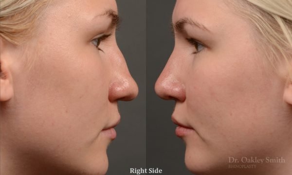 408 rhinoplasty, dr oakley smith, toronto, top surgeon, nose job