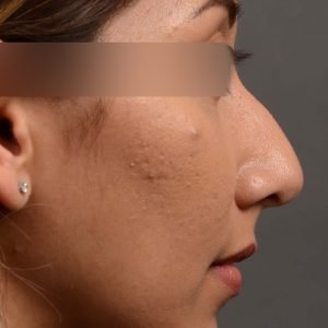 409 rhinoplasty, dr oakley smith, toronto, top surgeon, nose job