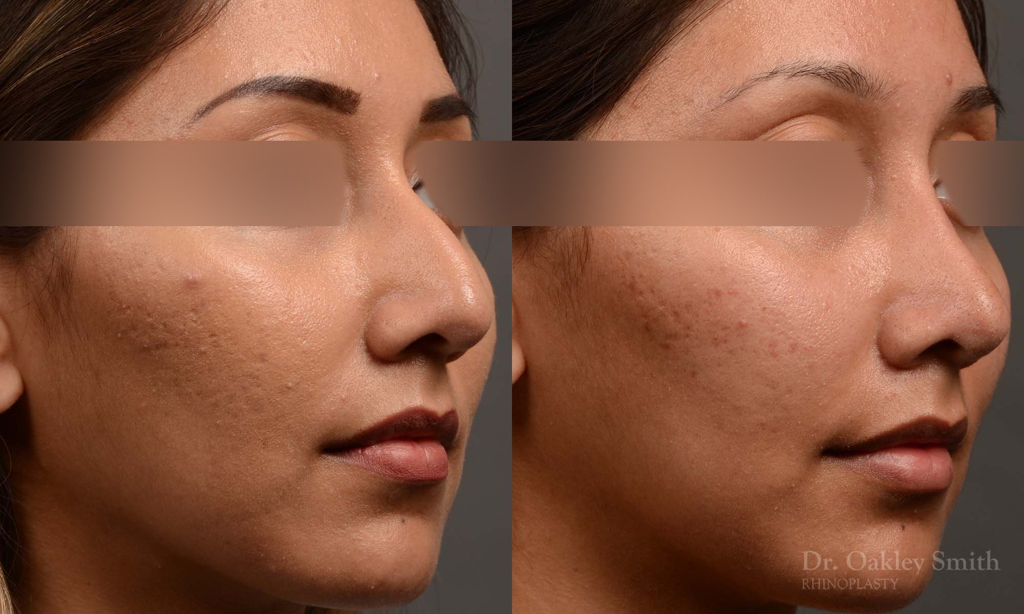 409 rhinoplasty, dr oakley smith, toronto, top surgeon, nose job