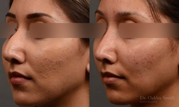 409 rhinoplasty, dr oakley smith, toronto, top surgeon, nose job