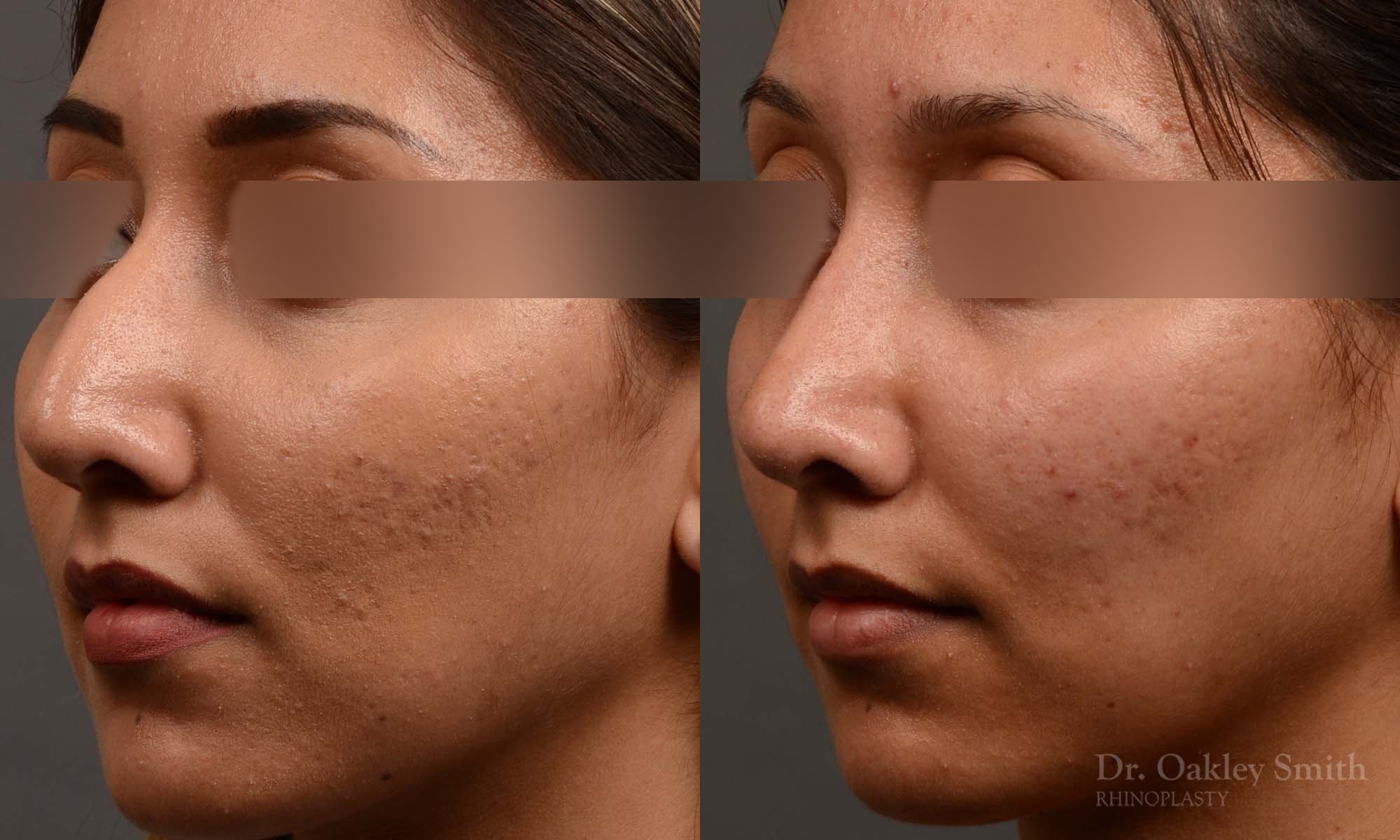 409 rhinoplasty, dr oakley smith, toronto, top surgeon, nose job