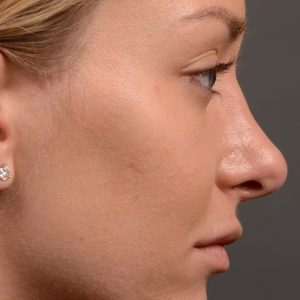 410 rhinoplasty, dr oakley smith, toronto, top surgeon, nose job