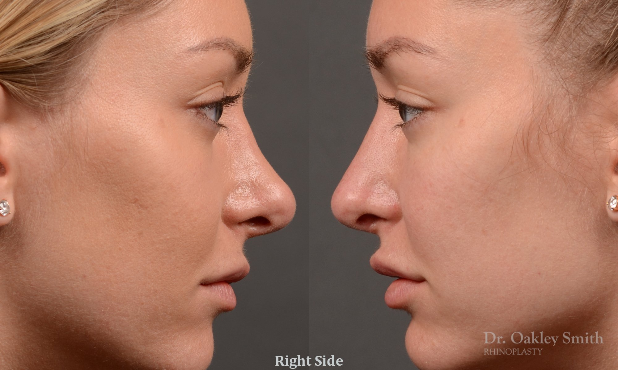 410 rhinoplasty, dr oakley smith, toronto, top surgeon, nose job