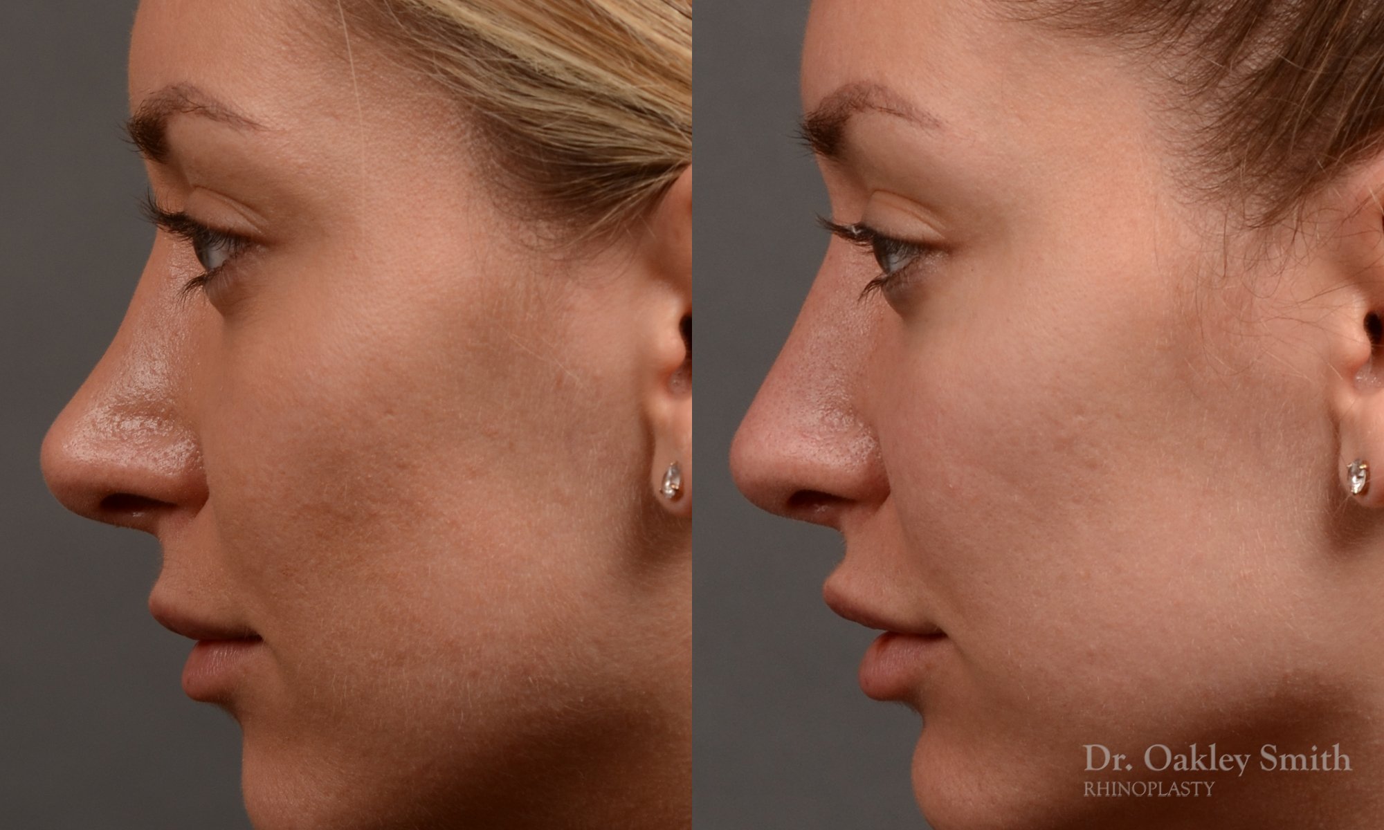410 rhinoplasty, dr oakley smith, toronto, top surgeon, nose job