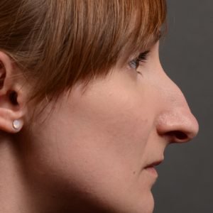 412 rhinoplasty, dr oakley smith, toronto, top surgeon, nose job