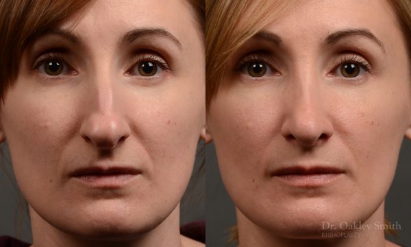 412 rhinoplasty, dr oakley smith, toronto, top surgeon, nose job