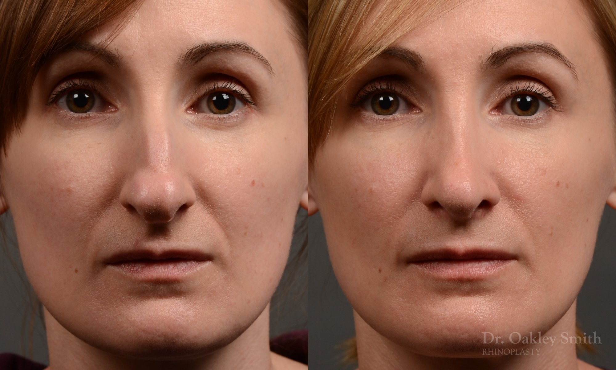 412 rhinoplasty, dr oakley smith, toronto, top surgeon, nose job