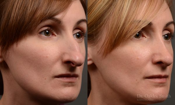 412 rhinoplasty, dr oakley smith, toronto, top surgeon, nose job