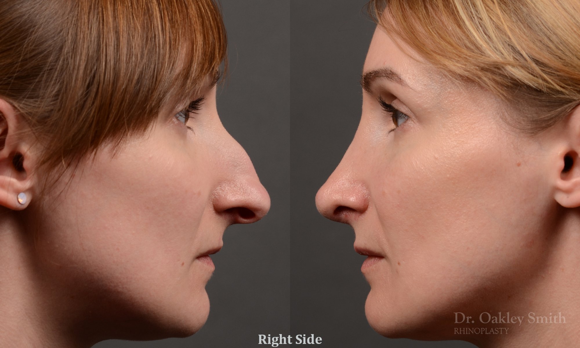 412 rhinoplasty, dr oakley smith, toronto, top surgeon, nose job