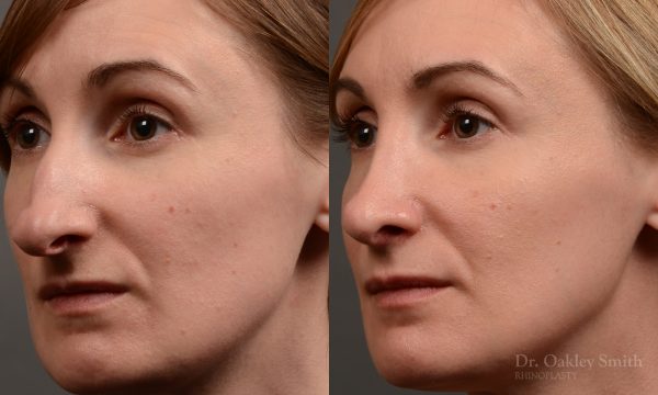 412 rhinoplasty, dr oakley smith, toronto, top surgeon, nose job