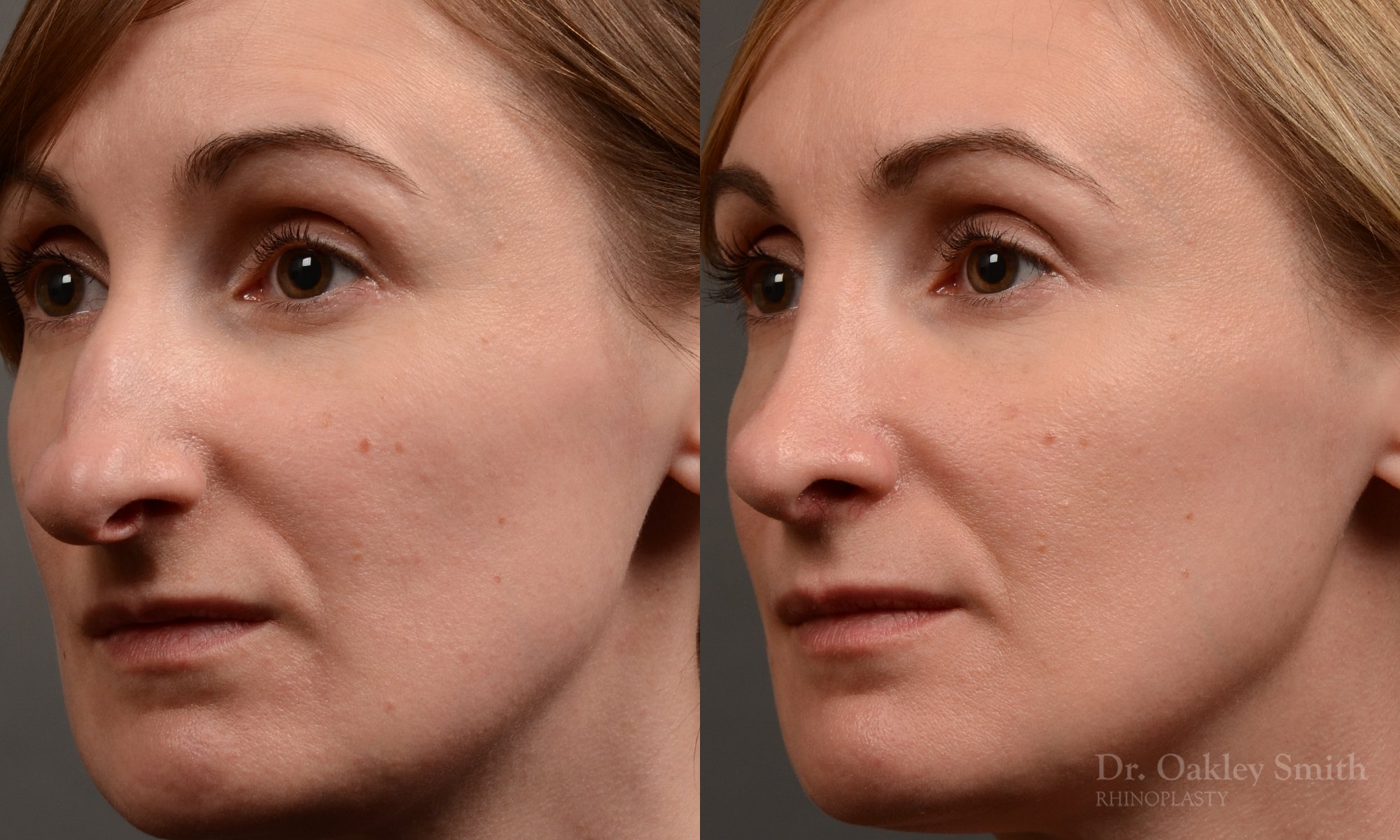 412 rhinoplasty, dr oakley smith, toronto, top surgeon, nose job