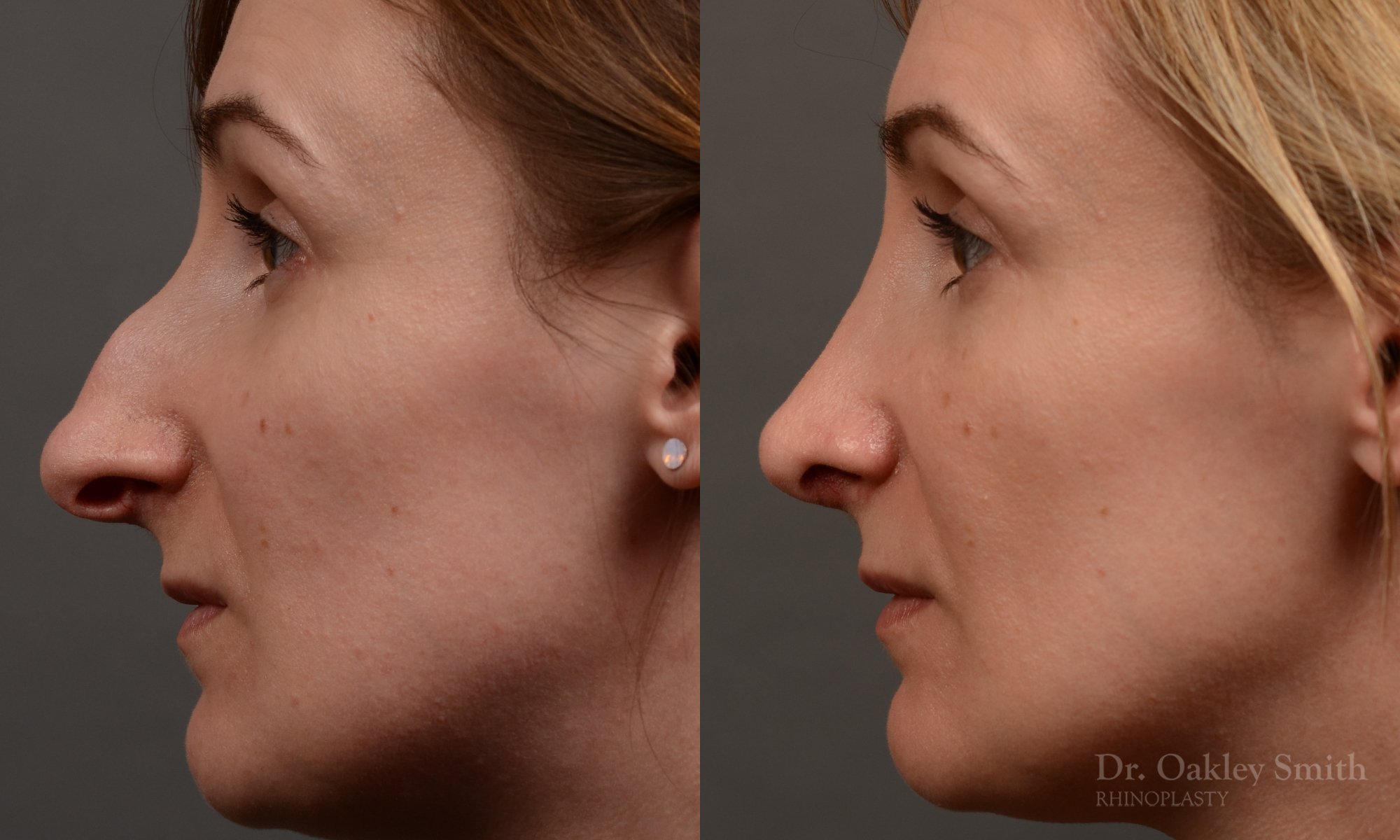 412 rhinoplasty, dr oakley smith, toronto, top surgeon, nose job