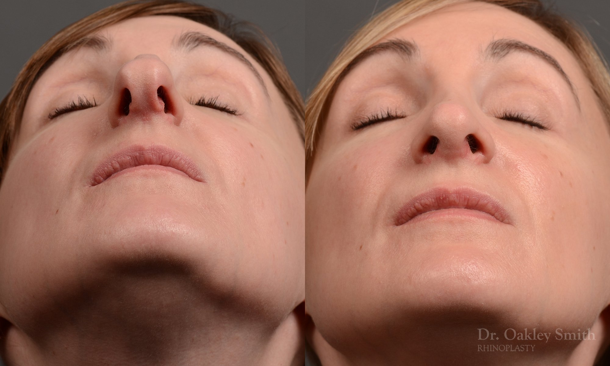412 rhinoplasty, dr oakley smith, toronto, top surgeon, nose job