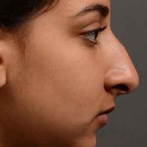 413 - expert toronto rhinoplasty surgery to remove the bulbous tip of this mans nose