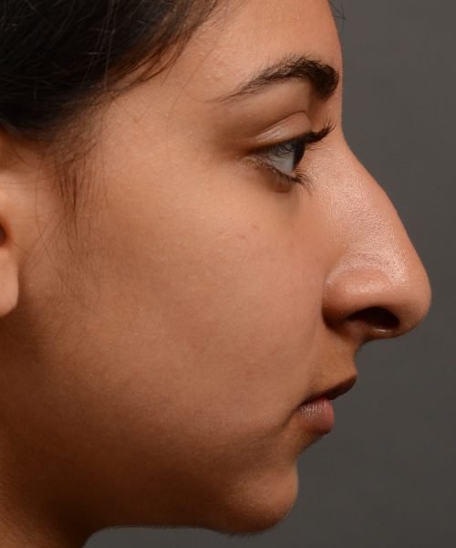 413 - expert toronto rhinoplasty surgery to remove the bulbous tip of this mans nose