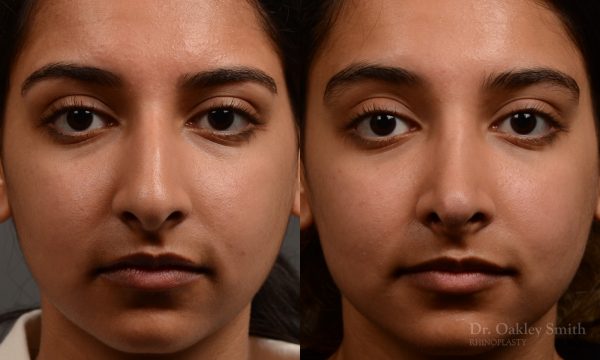 413 - expert toronto rhinoplasty surgery to remove the bulbous tip of this mans nose