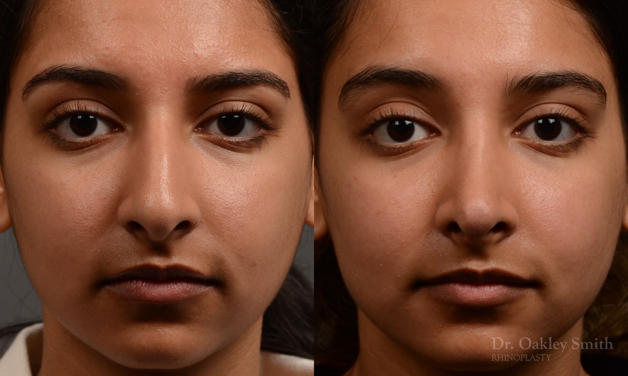 413 - expert toronto rhinoplasty surgery to remove the bulbous tip of this mans nose