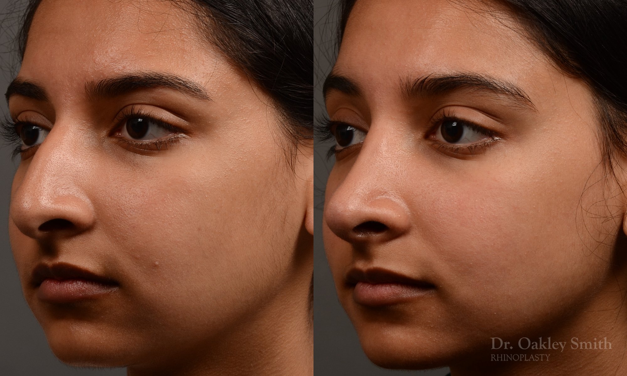413 - expert toronto rhinoplasty surgery to remove the bulbous tip of this mans nose