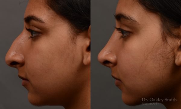 413 - expert toronto rhinoplasty surgery to remove the bulbous tip of this mans nose