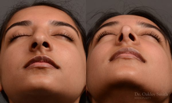 413 - expert toronto rhinoplasty surgery to remove the bulbous tip of this mans nose