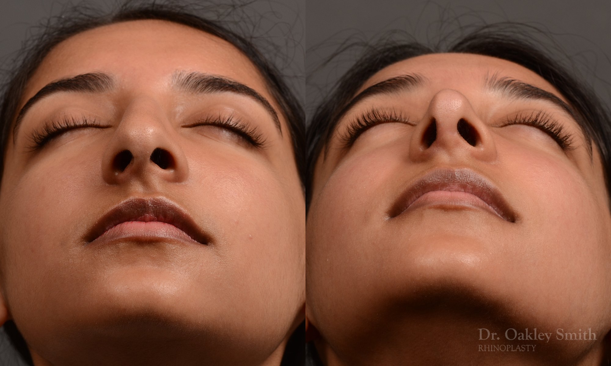 413 - expert toronto rhinoplasty surgery to remove the bulbous tip of this mans nose