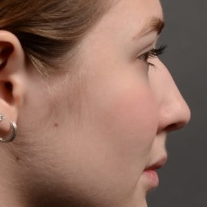 414 rhinoplasty, dr oakley smith, toronto, top surgeon, nose job