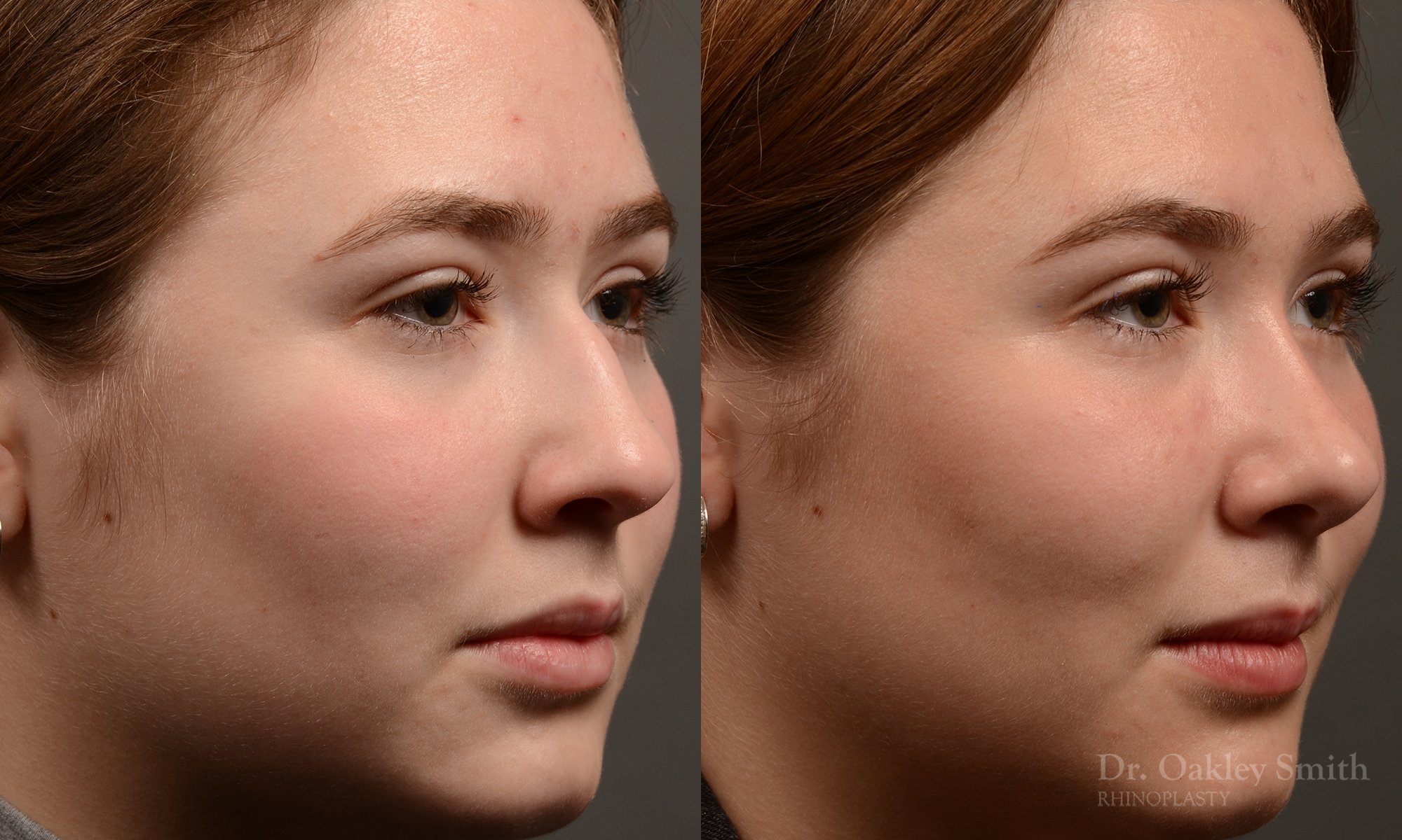 414 rhinoplasty, dr oakley smith, toronto, top surgeon, nose job