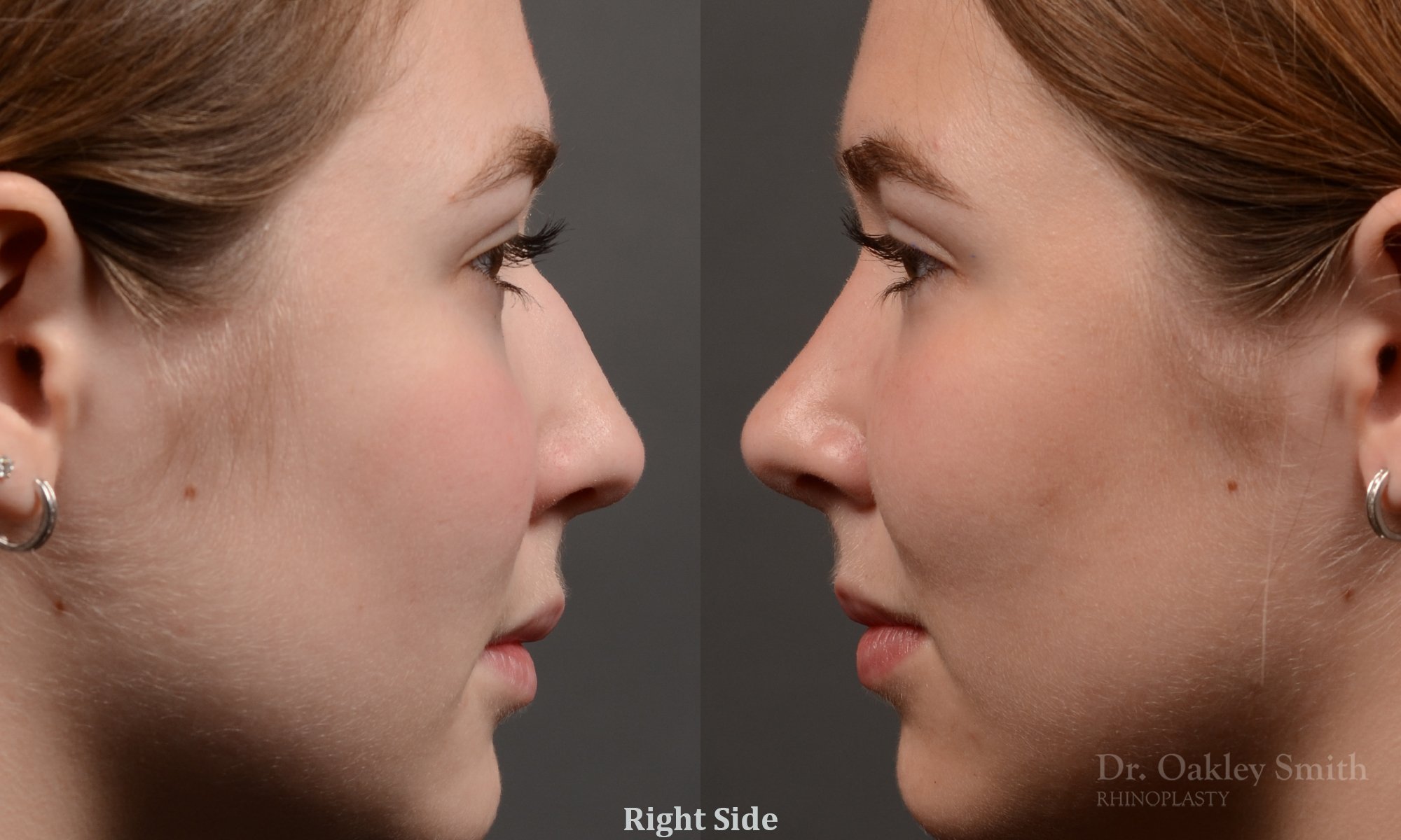 414 rhinoplasty, dr oakley smith, toronto, top surgeon, nose job