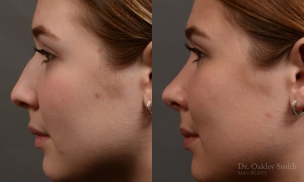 414 rhinoplasty, dr oakley smith, toronto, top surgeon, nose job