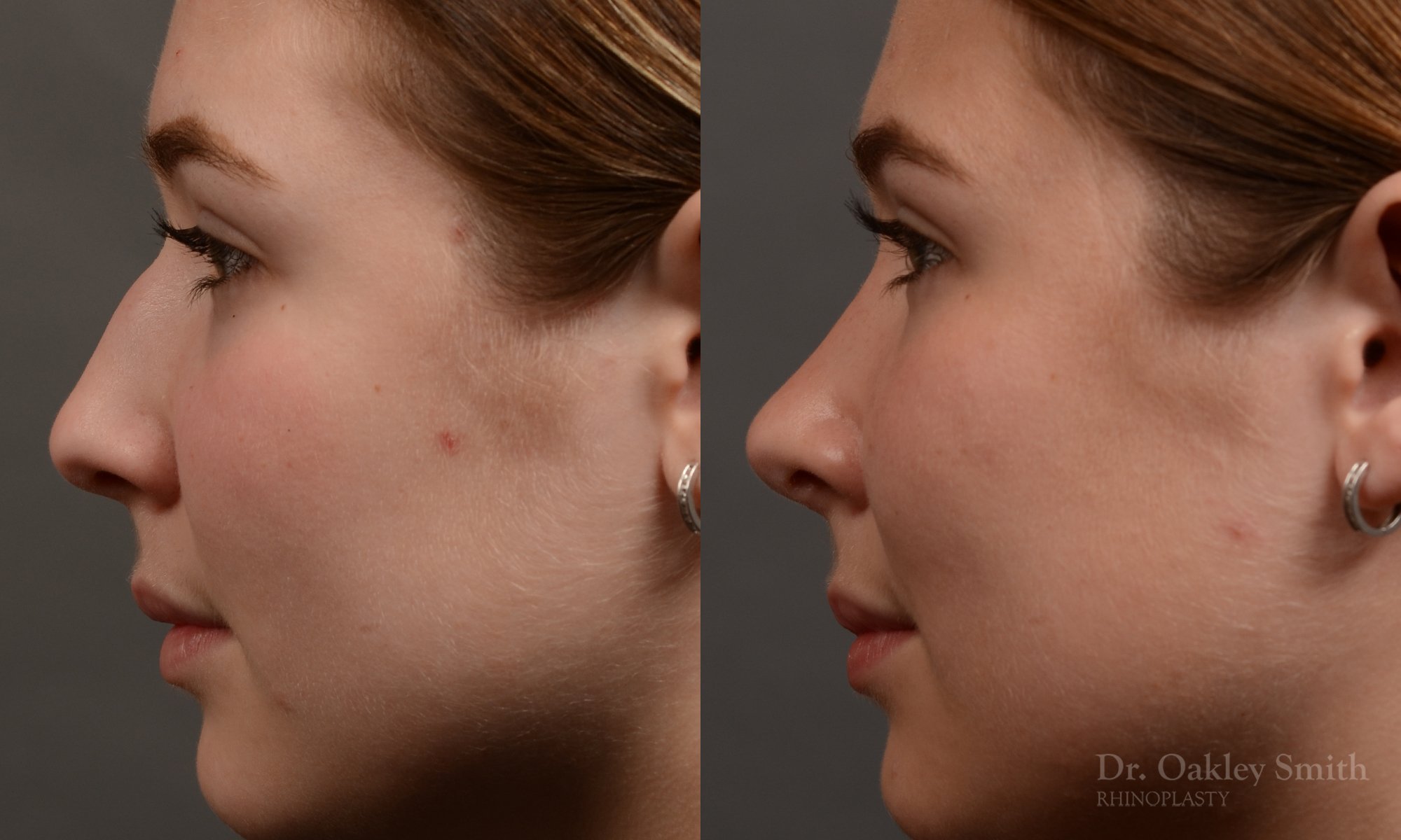 414 rhinoplasty, dr oakley smith, toronto, top surgeon, nose job