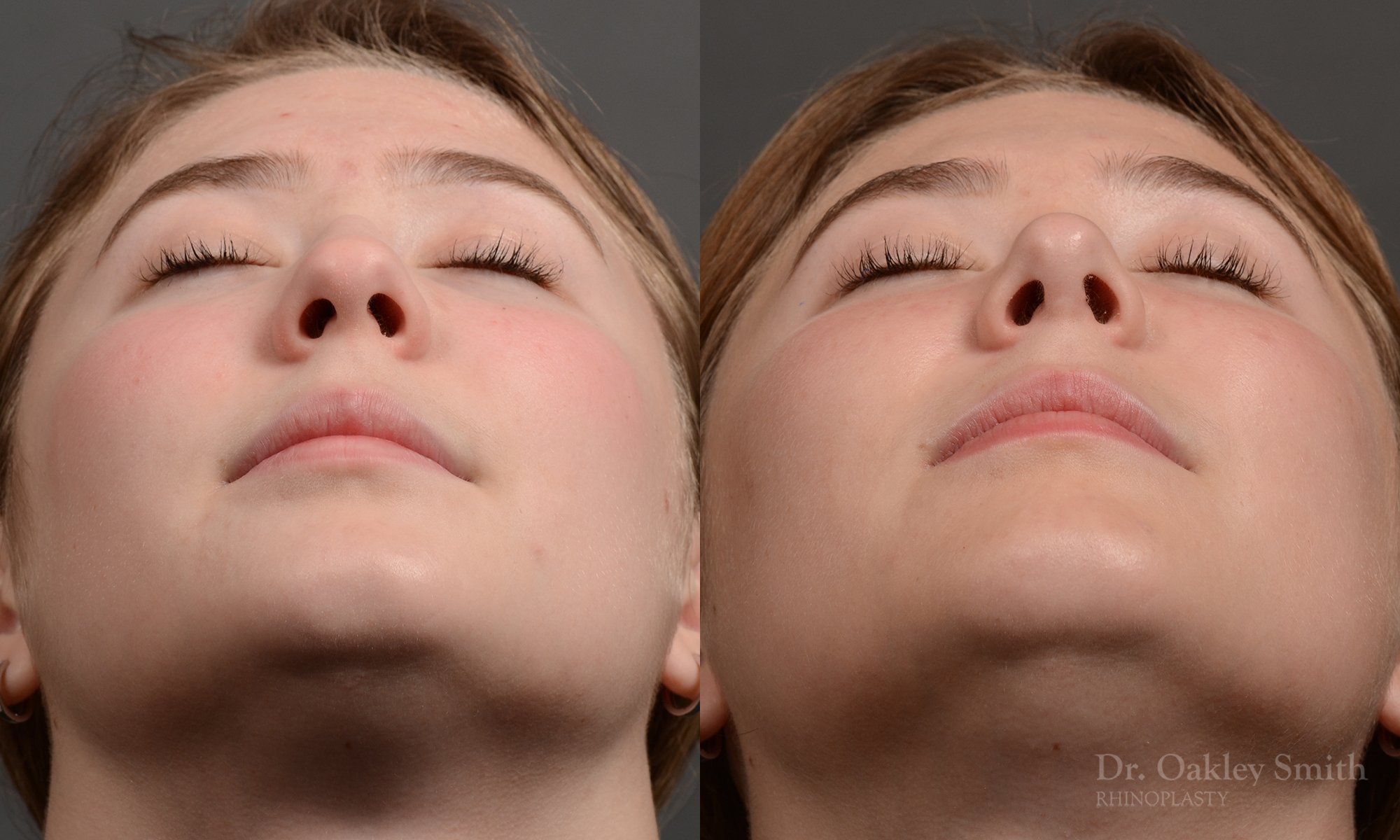 414 rhinoplasty, dr oakley smith, toronto, top surgeon, nose job